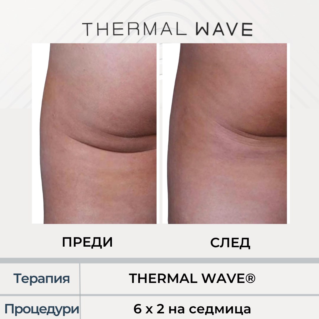 THERMAL WAVE резултат преди и след, седалище в Бургас