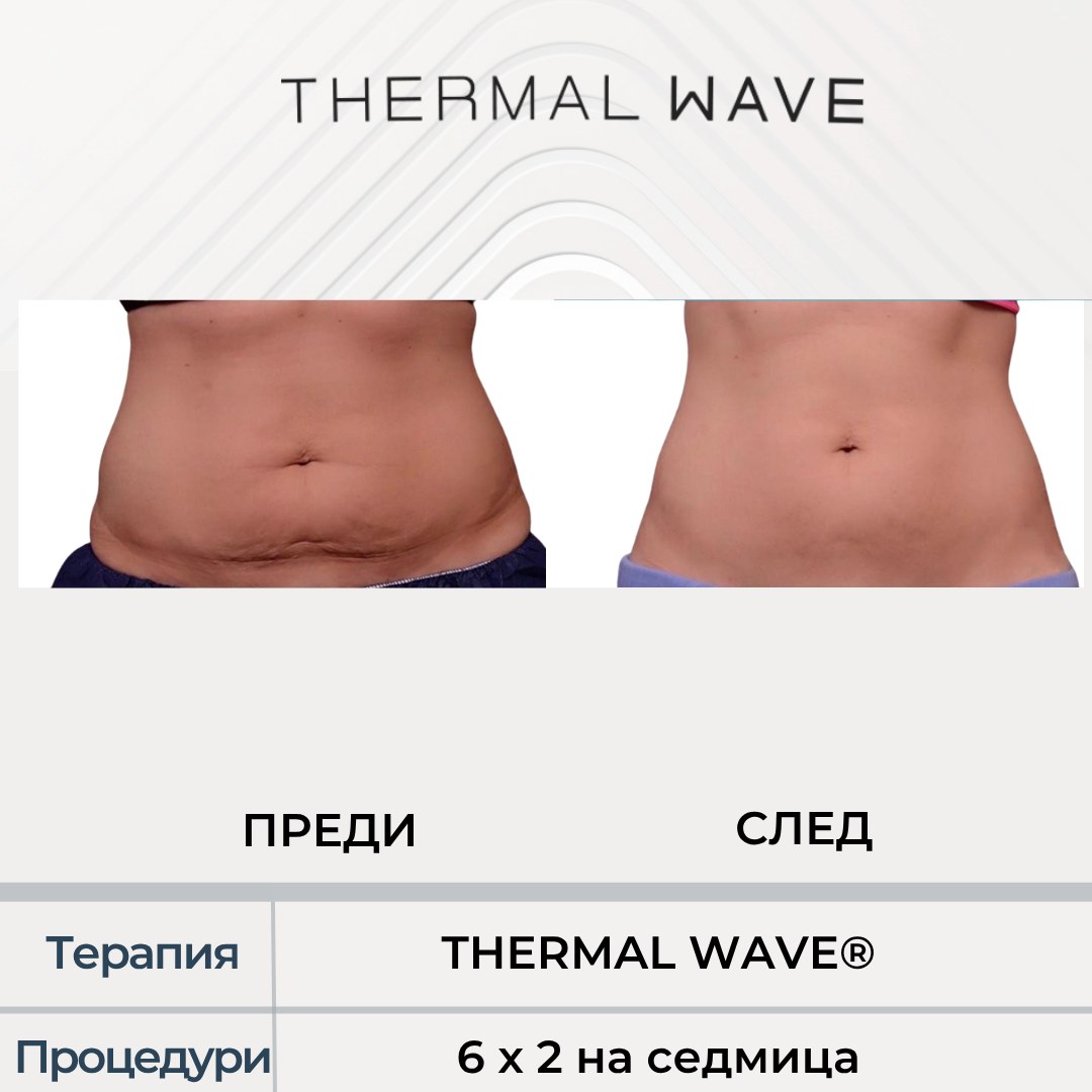 THERMAL WAVE резултат преди и след, корем в Бургас