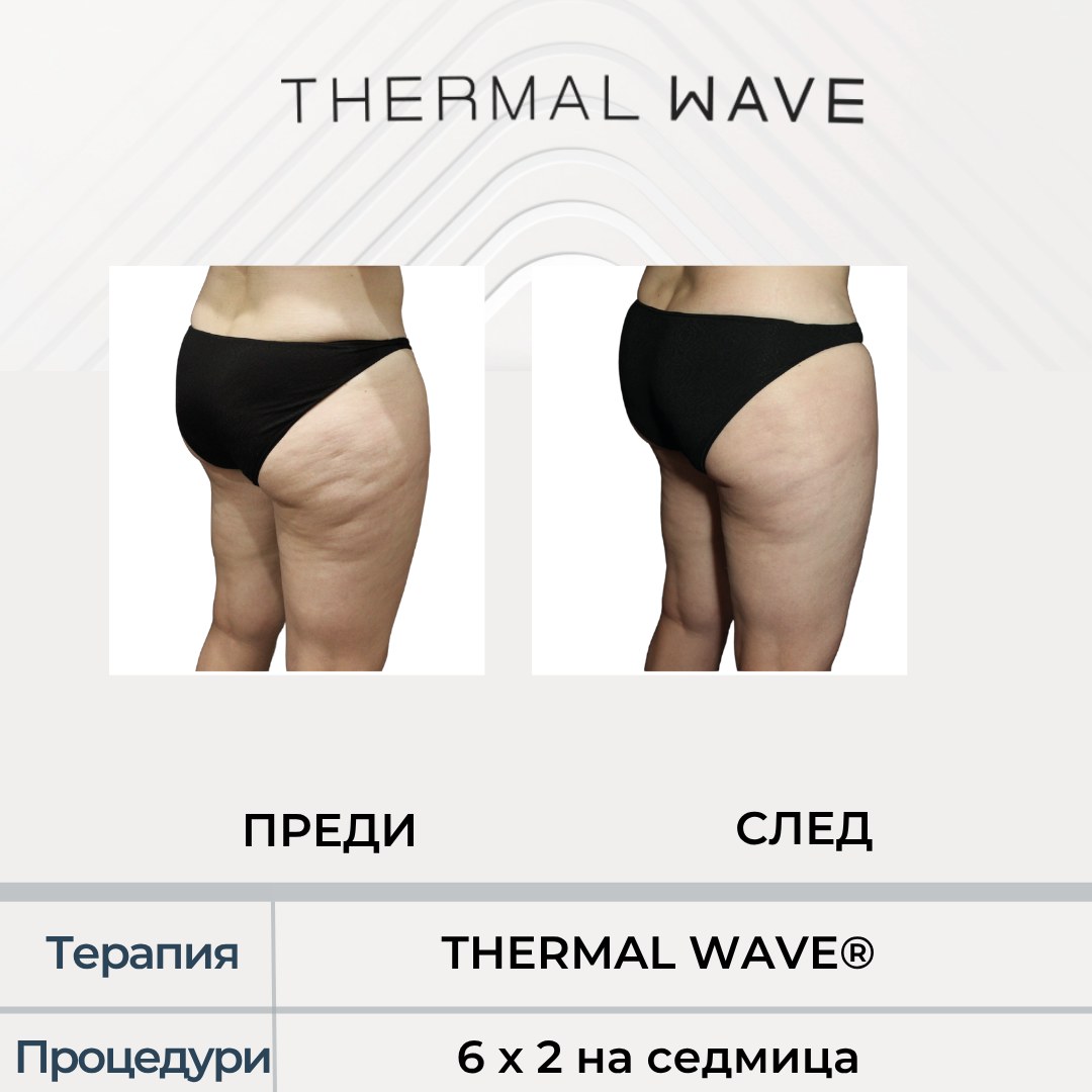 THERMAL WAVE резултат преди и след, бедра и седалище в Бургас