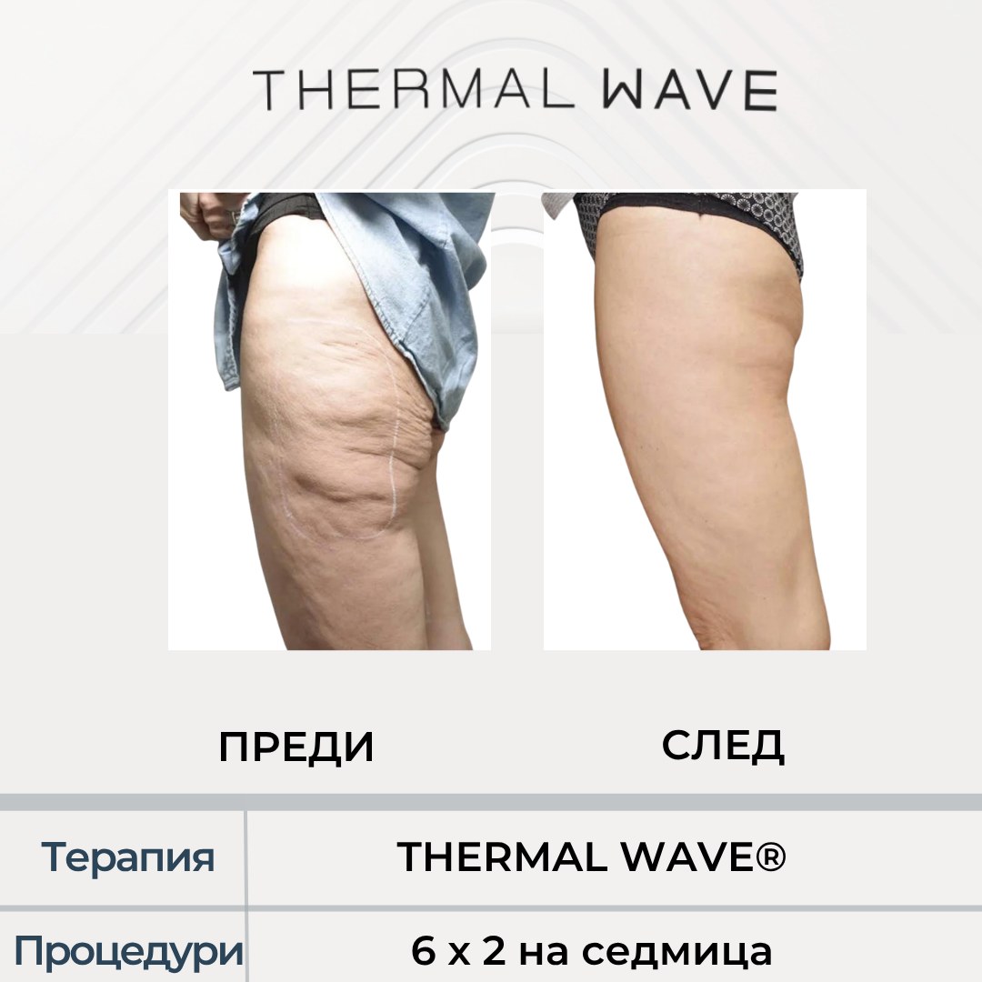 THERMAL WAVE резултат преди и след, бедра в Бургас