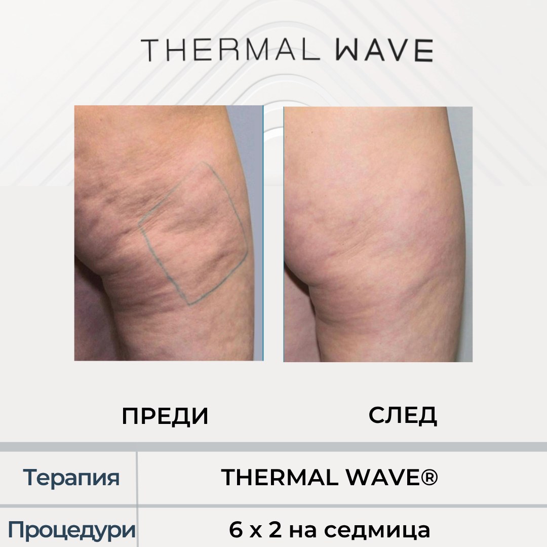 THERMAL WAVE резултат преди и след, целулит на бедрата в Бургас